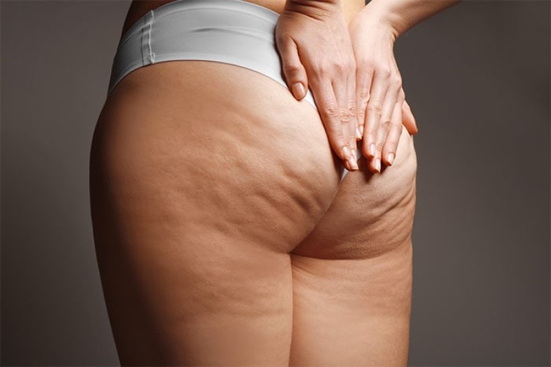 I segni e sintomi della cellulite